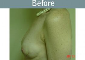 Milwaukee Plastic Surgery - Breast Reconstruction - 4-1