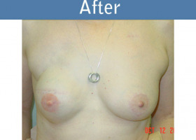Milwaukee Plastic Surgery - Breast Reconstruction - 5-1