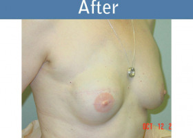 Milwaukee Plastic Surgery - Breast Reconstruction - 6-1