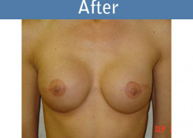 Milwaukee Plastic Surgery - Breast Reconstruction - 7-2