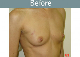 Milwaukee Plastic Surgery - Breast Reconstruction - 8-1