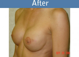 Milwaukee Plastic Surgery - Breast Reconstruction - 8-2