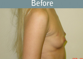 Milwaukee Plastic Surgery - Breast Reconstruction - 9-1