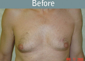 Milwaukee Plastic Surgery - Breast Reduction - Male - 1-1