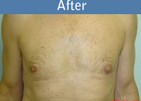 Milwaukee Plastic Surgery - Breast Reduction - Male - 1-2