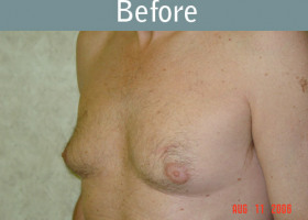 Milwaukee Plastic Surgery - Breast Reduction - Male - 2-1