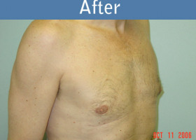 Milwaukee Plastic Surgery - Breast Reduction - Male - 2-2