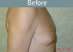 Milwaukee Plastic Surgery - Breast Reduction - Male - 3-1