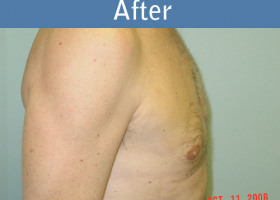 Milwaukee Plastic Surgery - Breast Reduction - Male - 3-2