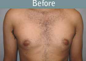 Milwaukee Plastic Surgery - Breast Reduction - Male - 4-1