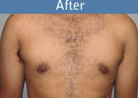 Milwaukee Plastic Surgery - Breast Reduction - Male - 4-2