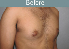Milwaukee Plastic Surgery - Breast Reduction - Male - 4-3