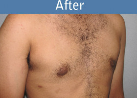 Milwaukee Plastic Surgery - Breast Reduction - Male - 4-4