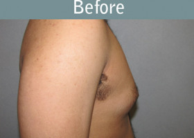 Milwaukee Plastic Surgery - Breast Reduction - Male - 4-5