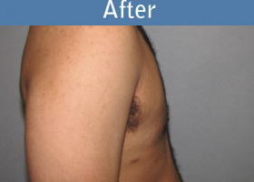 Milwaukee Plastic Surgery - Breast Reduction - Male - 4-6