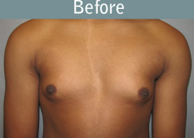 Milwaukee Plastic Surgery - Breast Reduction - Male - 5-1