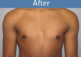 Milwaukee Plastic Surgery - Breast Reduction - Male - 5-2