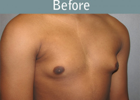 Milwaukee Plastic Surgery - Breast Reduction - Male - 5-3