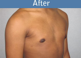 Milwaukee Plastic Surgery - Breast Reduction - Male - 5-4