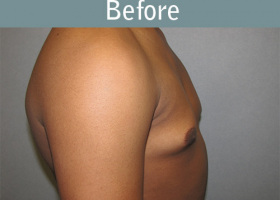 Milwaukee Plastic Surgery - Breast Reduction - Male - 5-5