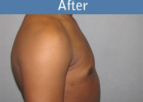 Milwaukee Plastic Surgery - Breast Reduction - Male - 5-6