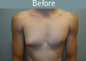 Milwaukee Plastic Surgery - Breast Reduction - Male - 6-1