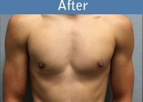 Milwaukee Plastic Surgery - Breast Reduction - Male - 6-2