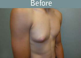 Milwaukee Plastic Surgery - Breast Reduction - Male - 6-3