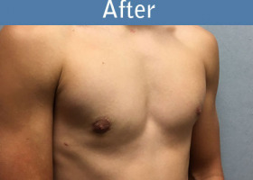 Milwaukee Plastic Surgery - Breast Reduction - Male - 6-4