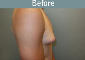 Milwaukee Plastic Surgery - Breast Reduction - Male - 6-5