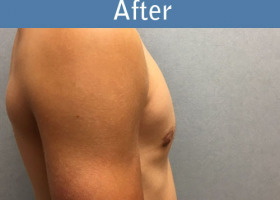Milwaukee Plastic Surgery - Breast Reduction - Male - 6-6