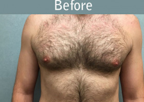 Milwaukee Plastic Surgery - Breast Reduction - Male - 7-1