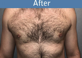 Milwaukee Plastic Surgery - Breast Reduction - Male - 7-2