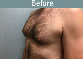 Milwaukee Plastic Surgery - Breast Reduction - Male - 7-3