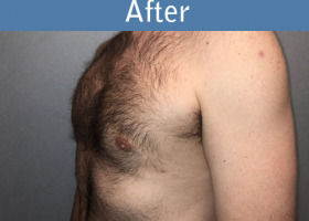 Milwaukee Plastic Surgery - Breast Reduction - Male - 7-4