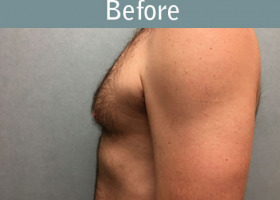Milwaukee Plastic Surgery - Breast Reduction - Male - 7-5