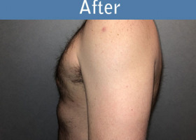 Milwaukee Plastic Surgery - Breast Reduction - Male - 7-6