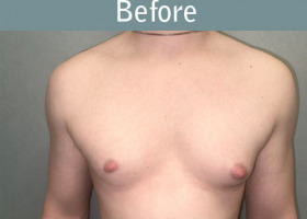 Milwaukee Plastic Surgery - Breast Reduction - Male - 8-1
