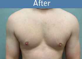 Milwaukee Plastic Surgery - Breast Reduction - Male - 8-2