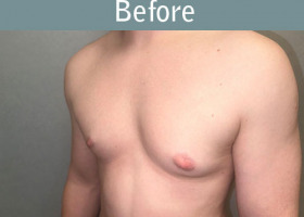 Milwaukee Plastic Surgery - Breast Reduction - Male - 8-3