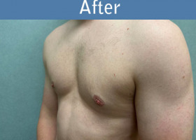 Milwaukee Plastic Surgery - Breast Reduction - Male - 8-4