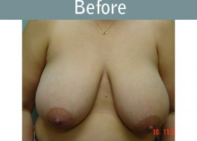 Milwaukee Plastic Surgery - Breast Reduction - 1-1