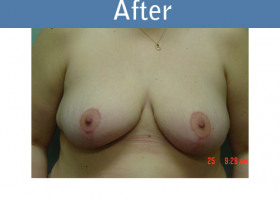Milwaukee Plastic Surgery - Breast Reduction - 1-2