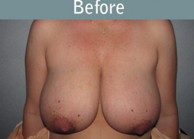 Milwaukee Plastic Surgery - Breast Reduction - 10-1