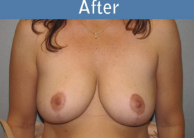 Milwaukee Plastic Surgery - Breast Reduction - 10-2
