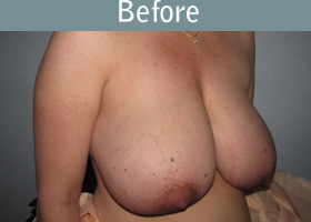 Milwaukee Plastic Surgery - Breast Reduction - 11-1