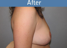 Milwaukee Plastic Surgery - Breast Reduction - 12-2