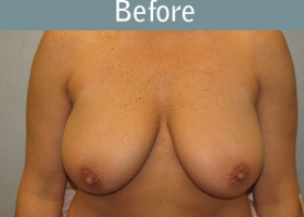 Milwaukee Plastic Surgery - Breast Reduction - 13-1