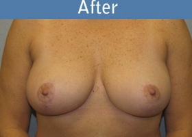 Milwaukee Plastic Surgery - Breast Reduction - 13-2