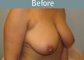 Milwaukee Plastic Surgery - Breast Reduction - 14-1